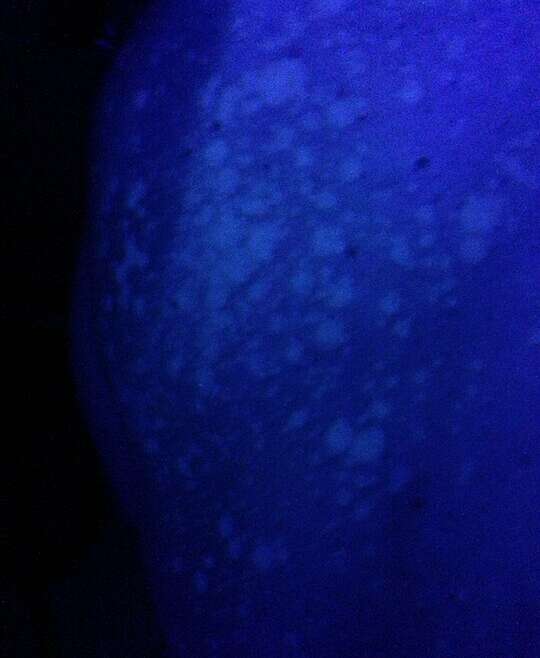 Łupież pstry – co to jest?