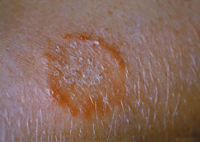 Grzybica skóry – przyczyny, objawy, leczenie