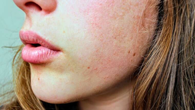 Suchość skóry – jak sobie z nią radzić?
